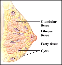 Image of fibrocystic breasts