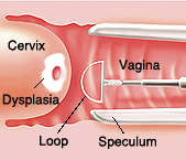 View of colposcope in vagina