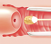 View of colposcope in vagina