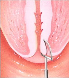 Image of cutting tissue